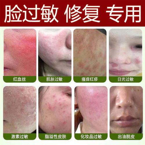 面部过敏用什么药膏