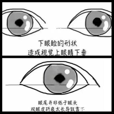 眼角下垂是什么眼