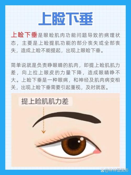 眼角下垂是什么眼