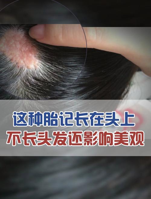 头上有胎记代表什么