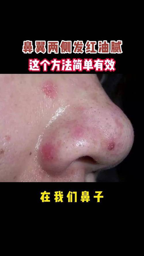 鼻子出油是什么皮肤