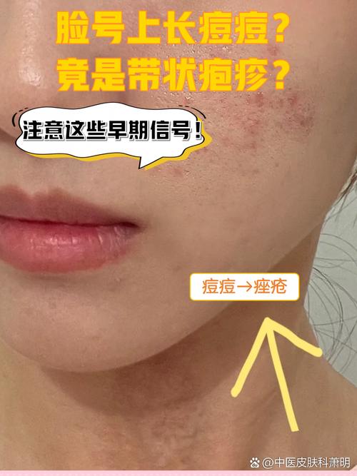 为什么脸上长疮