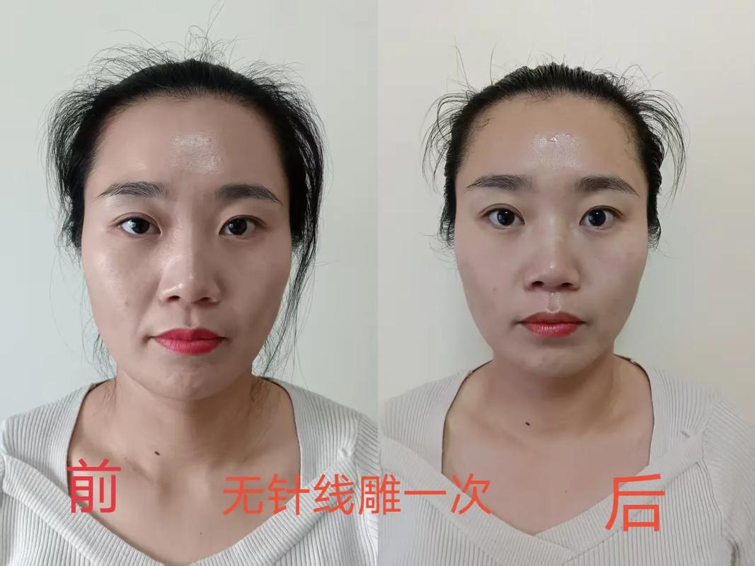线雕减肥的原理是什么