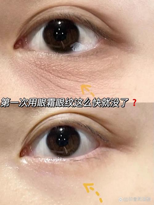 什么去眼纹效果好