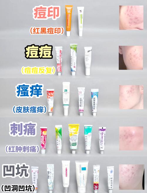 什么药膏可以去痘印