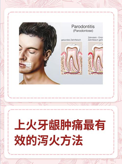 牙龈肿痛是什么火