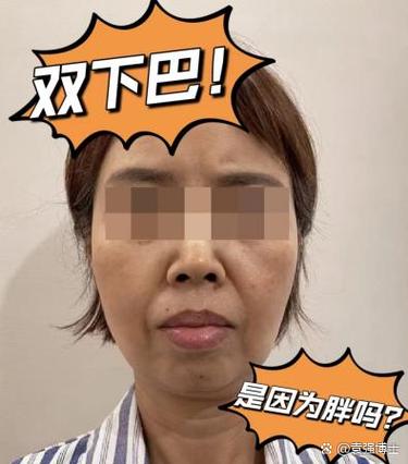 为什么会长双下巴