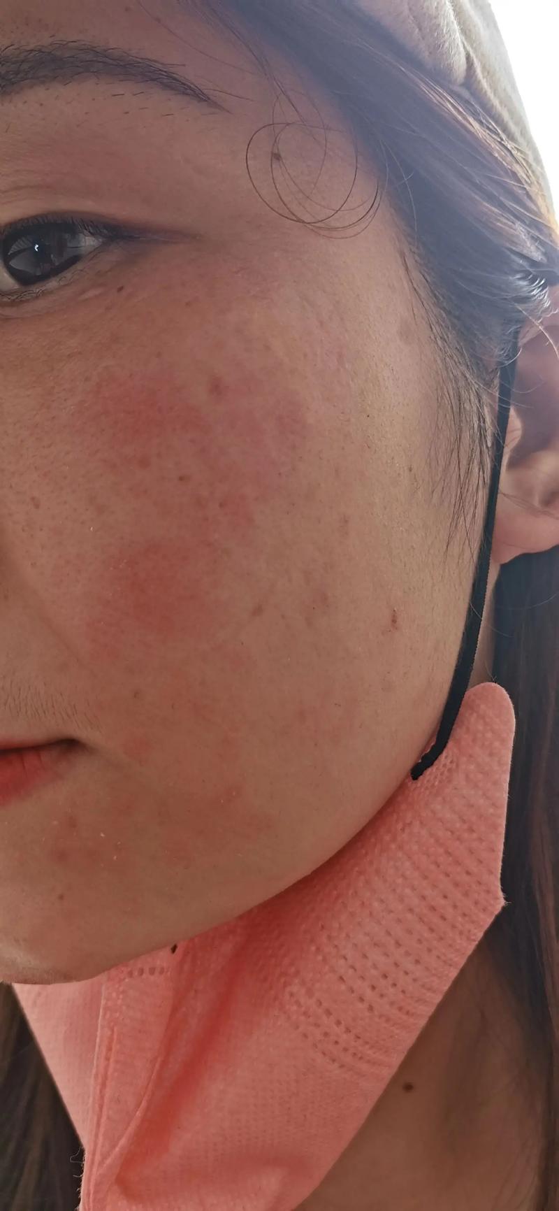 脸对什么过敏