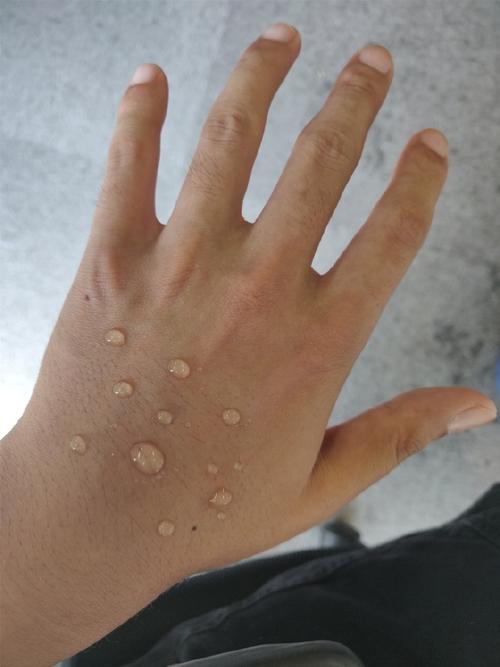 水痘是什么样的图片