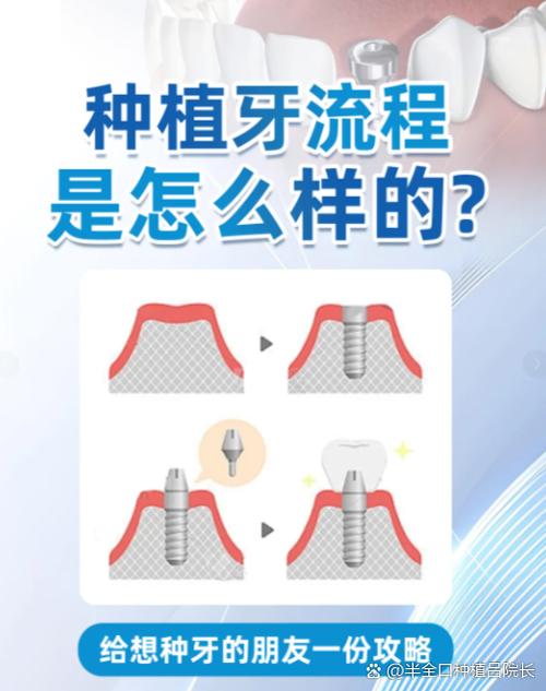 为什么种植牙那么贵