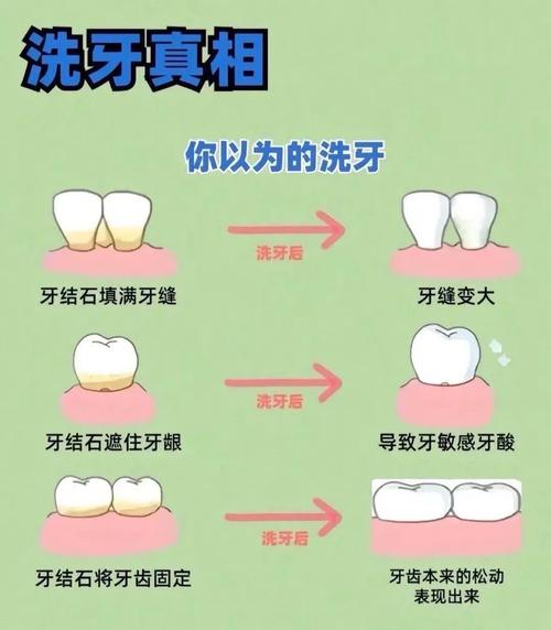 洗牙为什么会酸