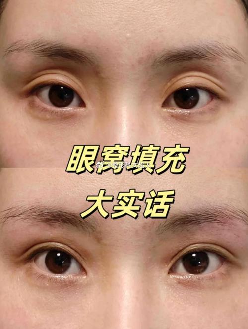 为什么眼睛会凹进去