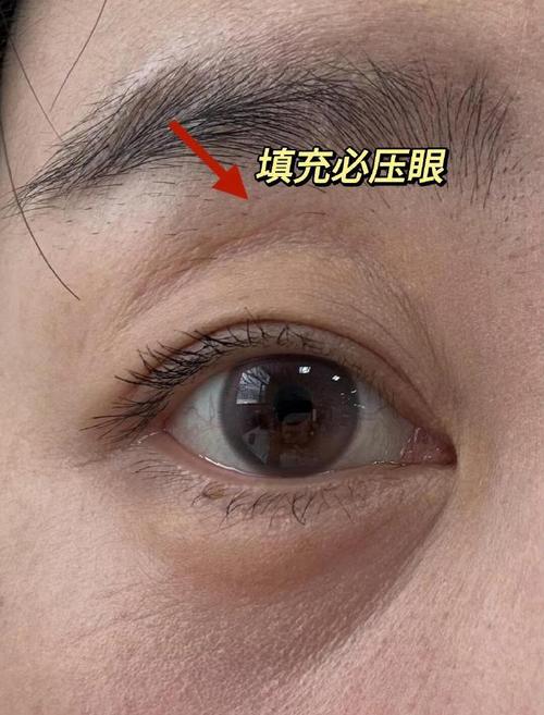 为什么眼睛会凹进去