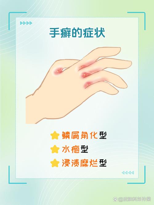 手癣是什么引起的