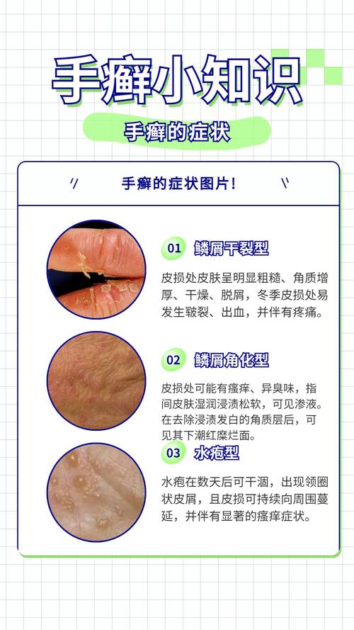 手癣是什么引起的