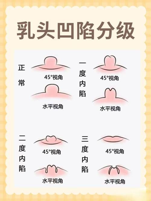 乳晕什么颜色正常