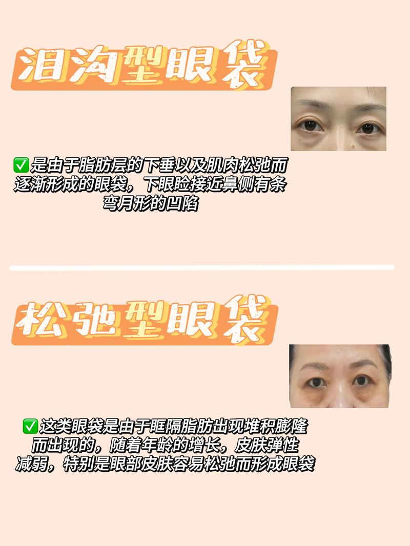 眼袋红肿是什么原因