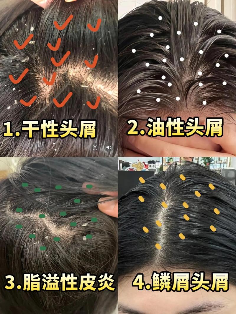头脱皮是什么原因