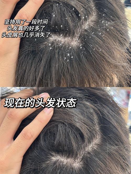 头脱皮是什么原因