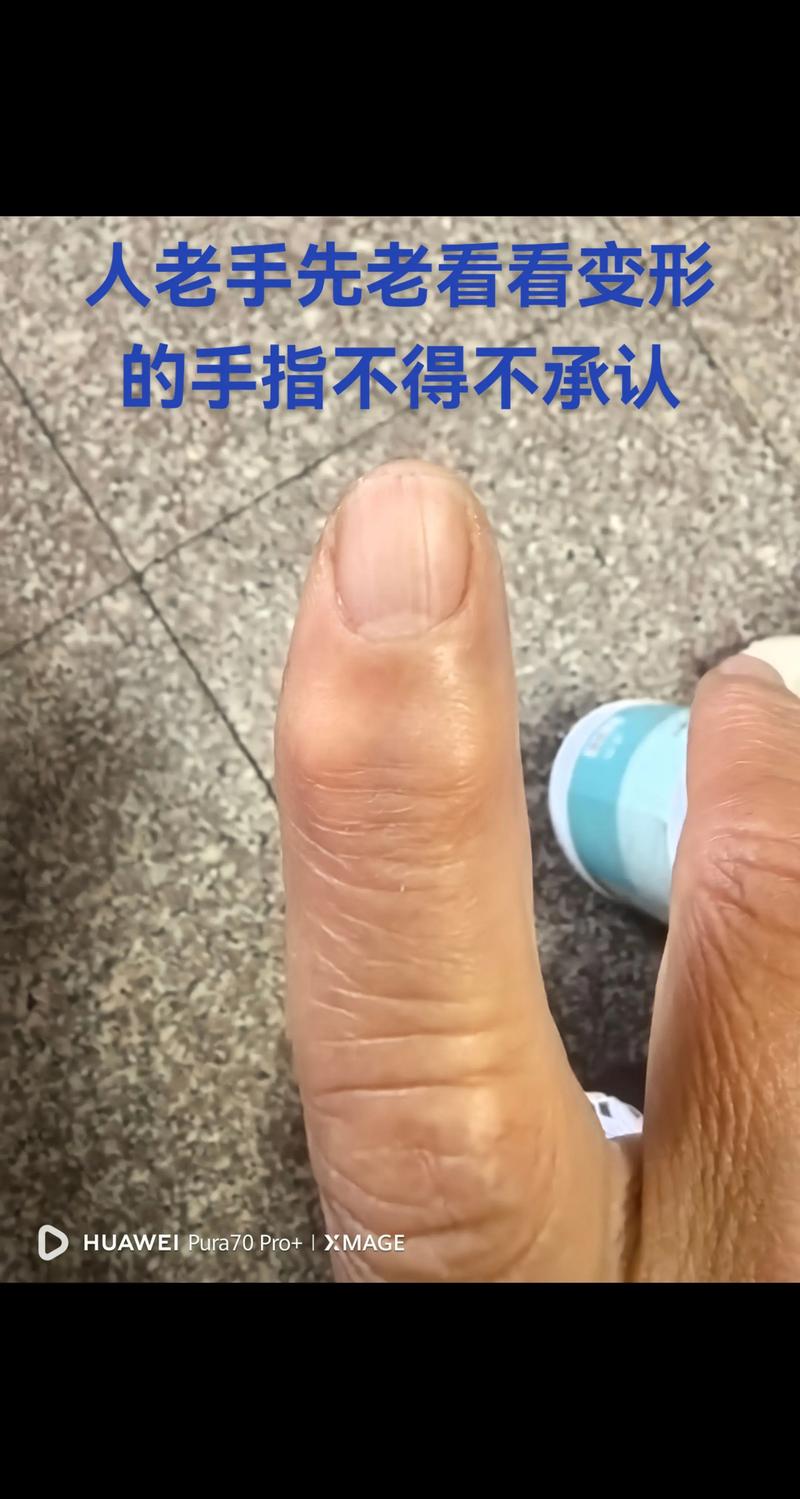 手指为什么会变粗