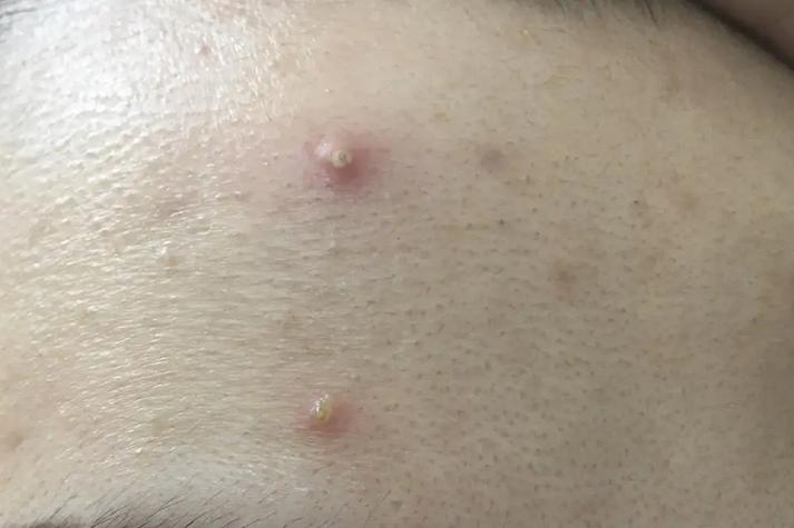 痘痘里的脓是什么