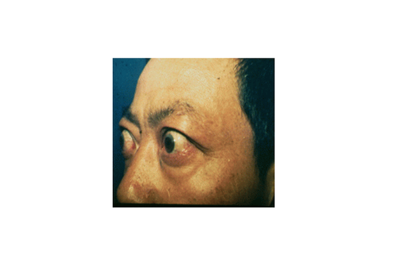 突眼是什么