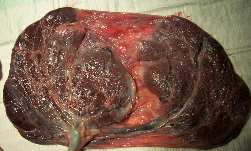 胎盘是什么样的图片