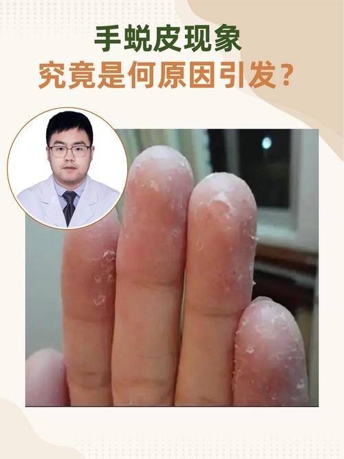 手掌掉皮是什么原因