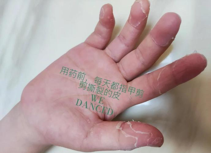 手掌掉皮是什么原因