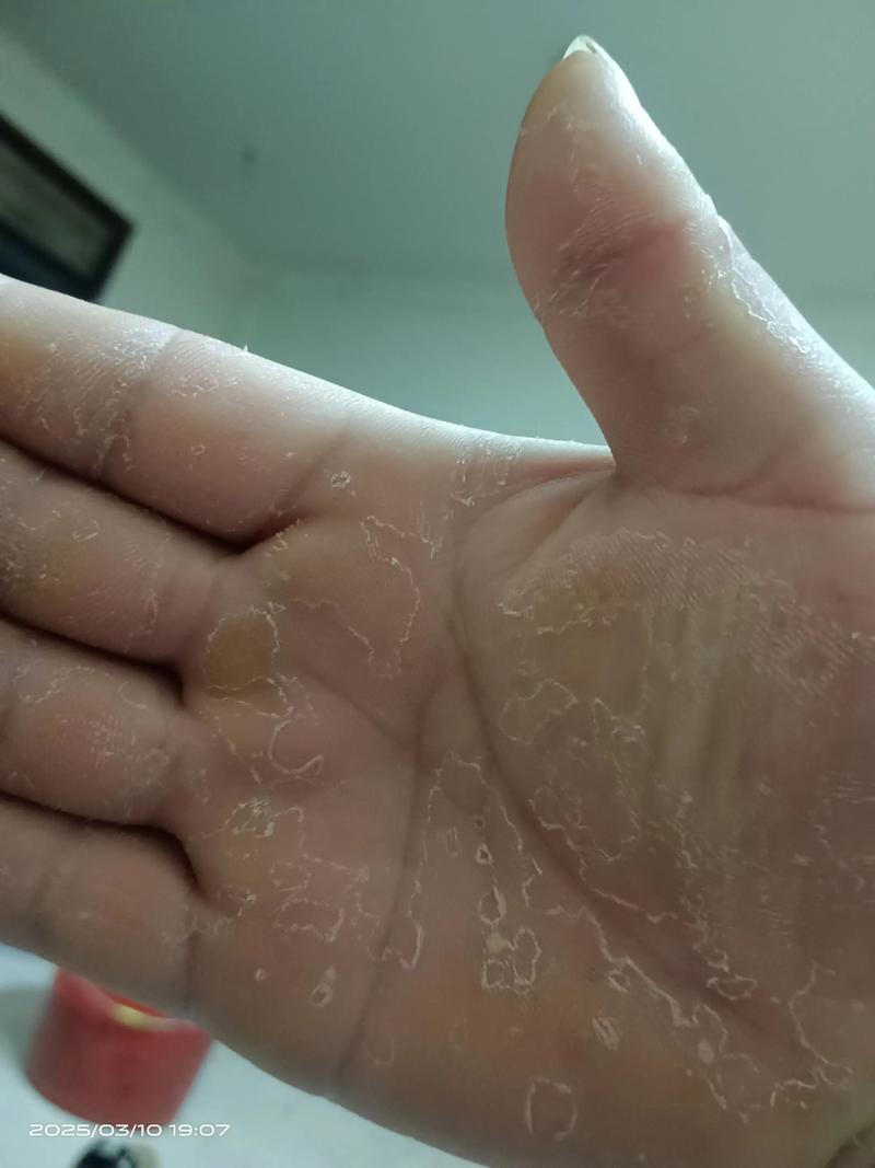 手掌掉皮是什么原因