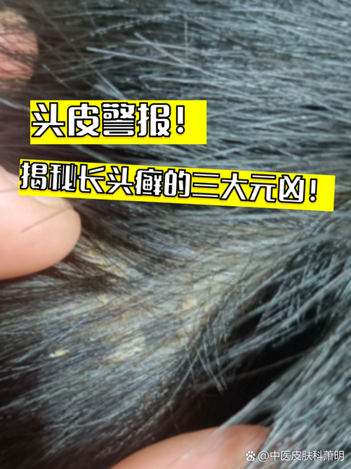 头癣是什么引起的