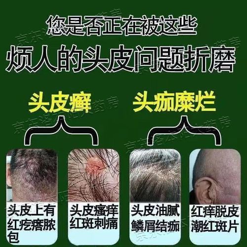 头癣是什么引起的