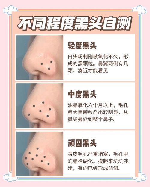什么能溶解黑头