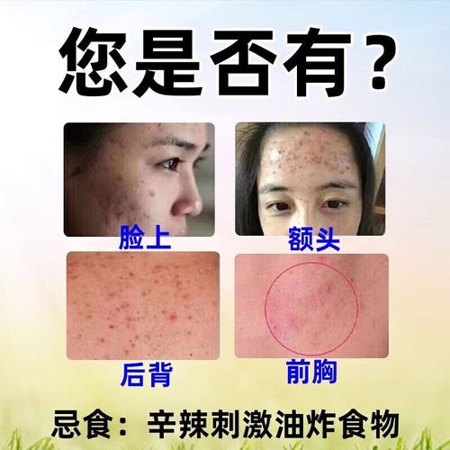 长粉刺吃什么