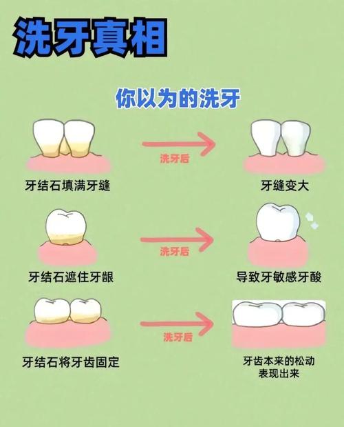 洁牙有什么好处
