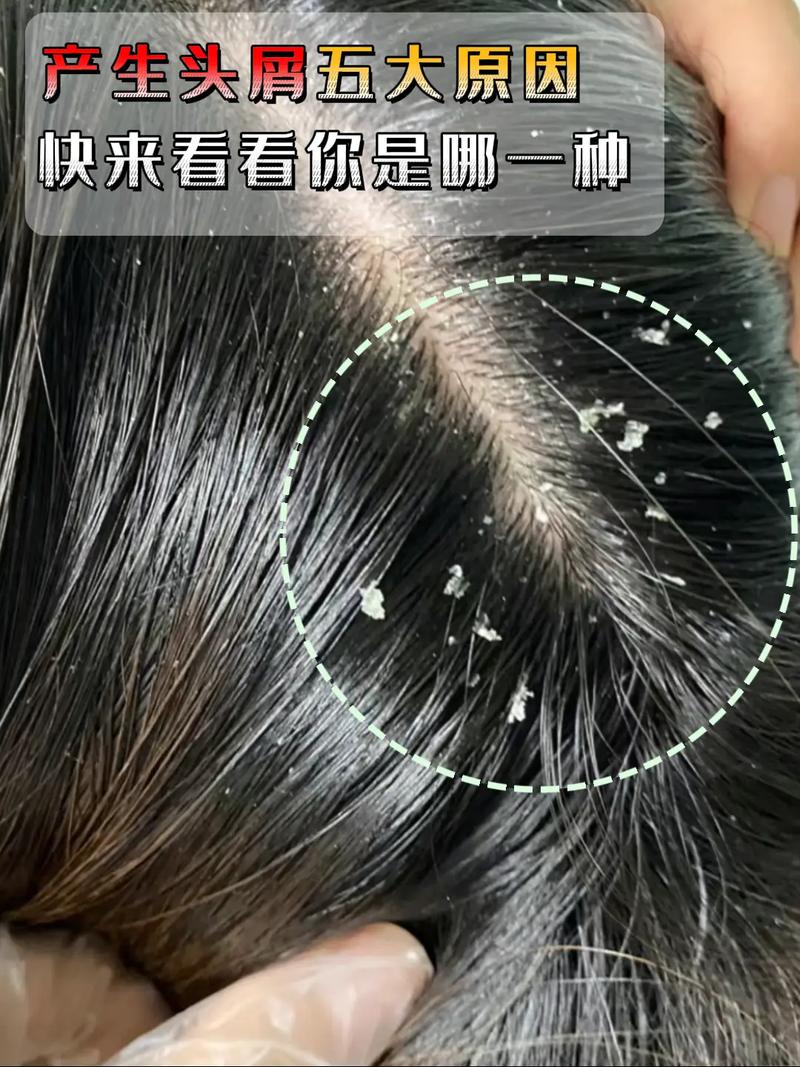 为什么有很多头皮屑