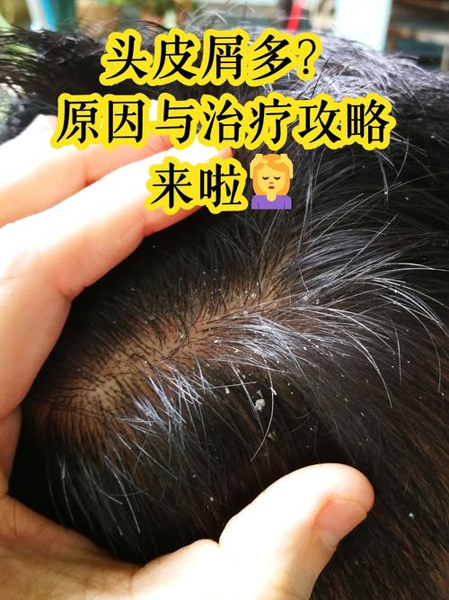 为什么有很多头皮屑