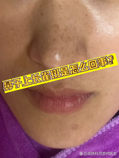 鼻子长斑什么原因