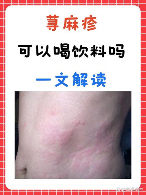 皮肤过敏喝什么
