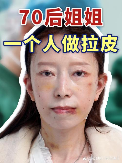 什么是拉皮手术