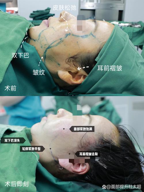 什么是拉皮手术