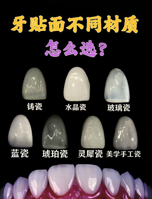 牙齿贴面什么意思