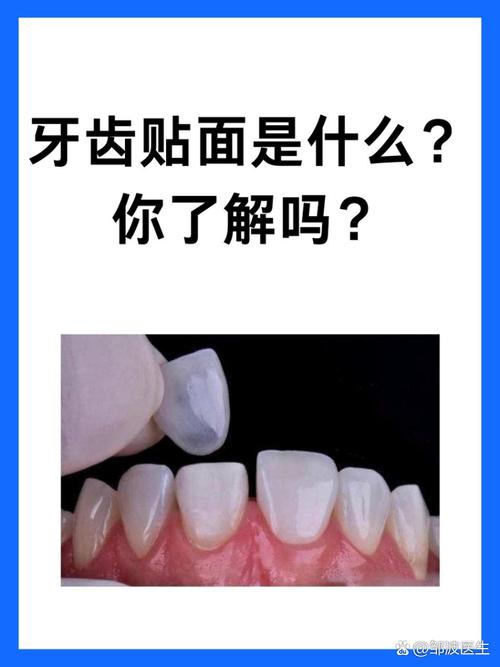 牙齿贴面什么意思