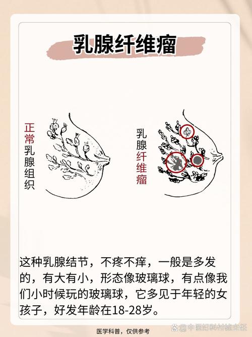 乳房为什么有结节