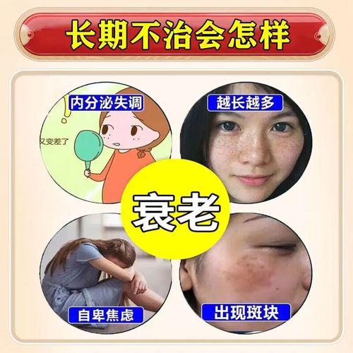 有什么中药祛斑