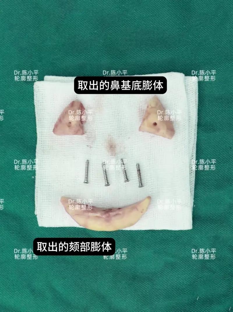 鼻子膨体是什么