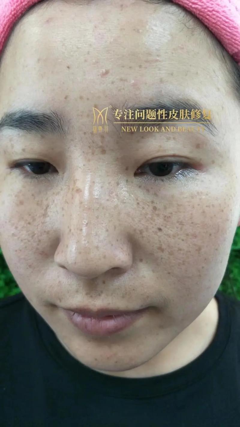 什么是遗传斑