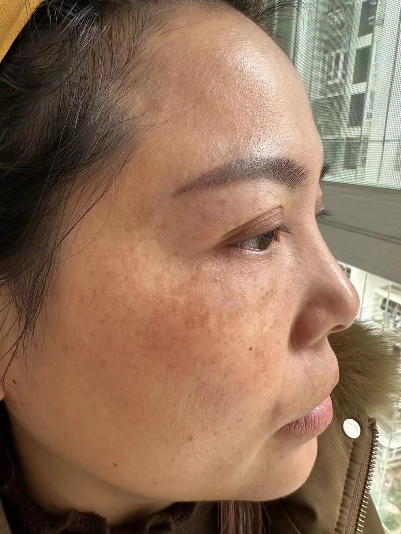 什么是遗传斑