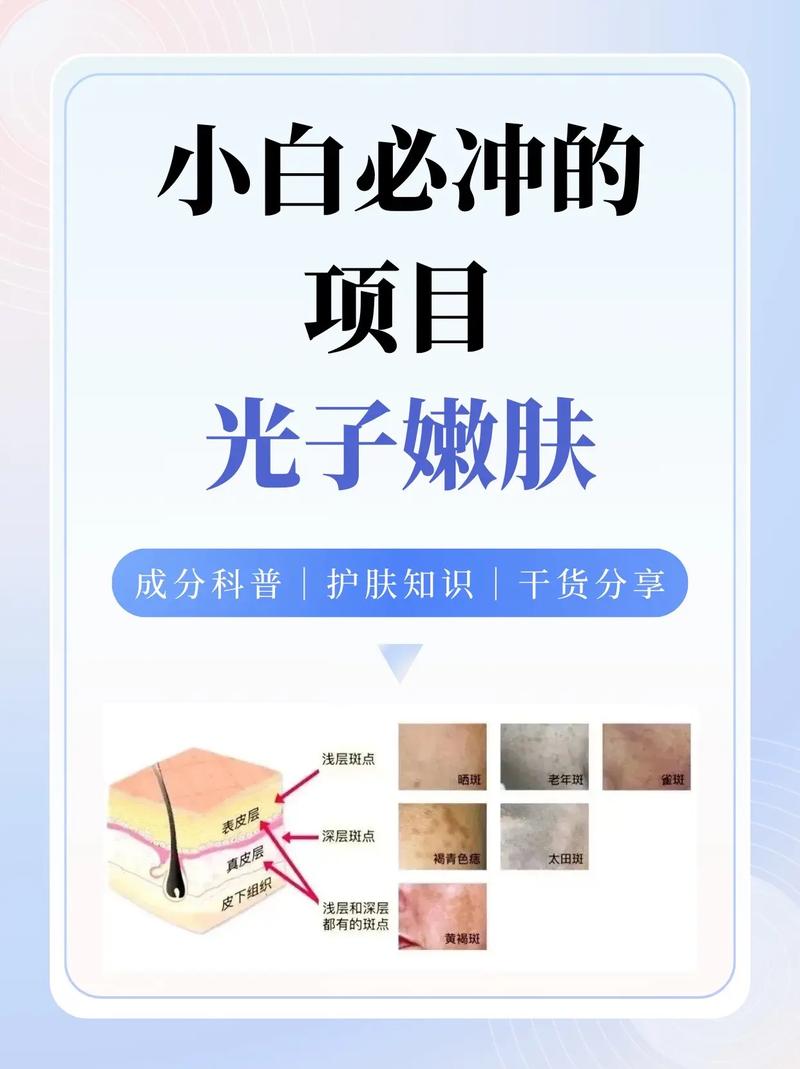 什么叫光子嫩肤