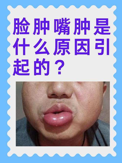 脸会肿是什么原因